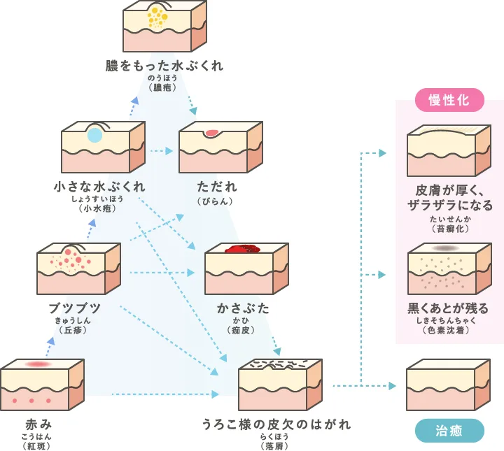 湿疹によるかゆみ・ブツブツ  湿疹とは主に、かゆみや湿り気を伴うブツブツとした皮疹のことをいいます。この状態が徐々に変化して、紅斑（発赤）や水泡（水ぶくれ）をはじめ、表皮の角質が白く浮いてはがれ落ちるといった症状がみられることもあります。