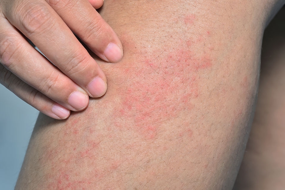 あせも（汗疹）