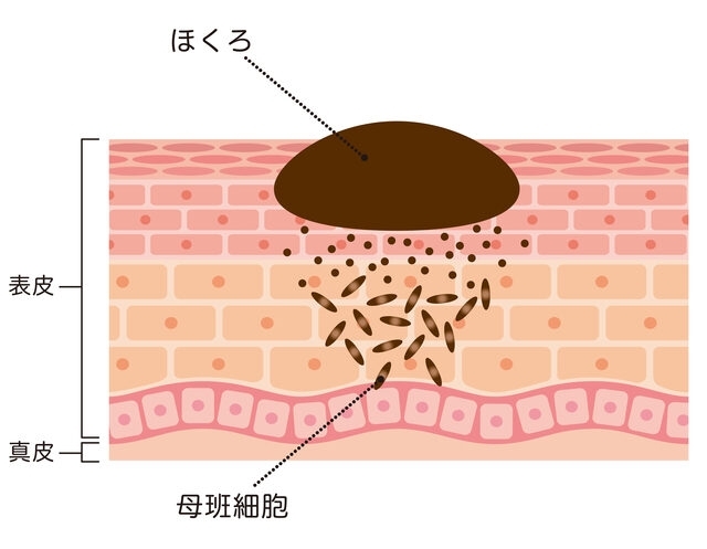 ほくろ