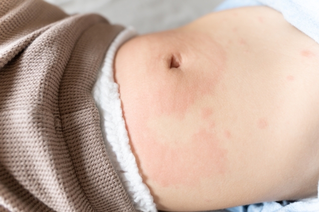 子どものじんましん