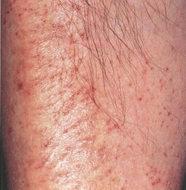 皮脂欠乏性皮膚炎とは？