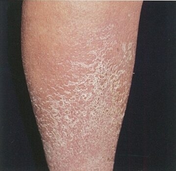 うっ滞性皮膚炎とは？