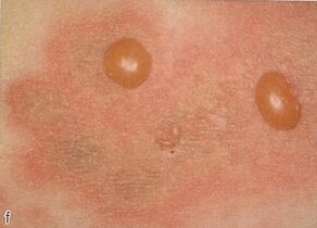 水疱性類天疱瘡とは？