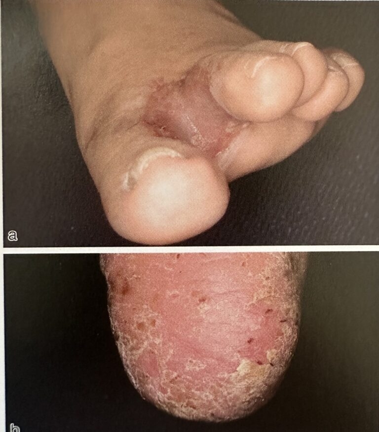 足白癬、カンジダ間擦疹とは？