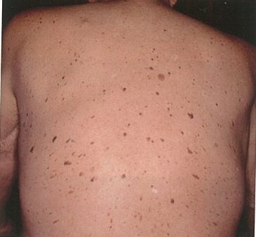 脂漏性角化症とは？