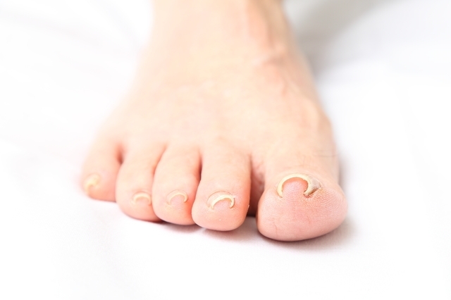 巻き爪の症状と原因