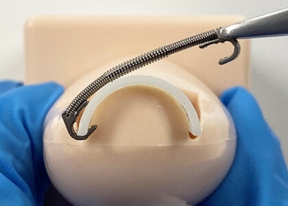 巻き爪（陥入爪）の治療