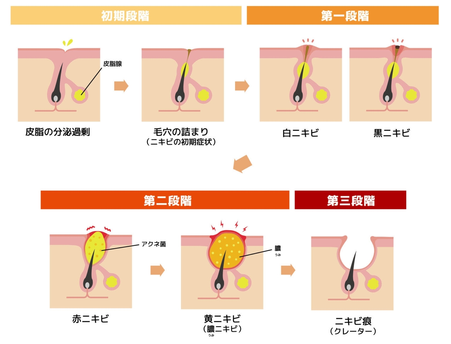 にきびが出た場合は、なるべく早めに皮膚科を受診して相談しましょう。にきびを潰すと炎症が悪化するので避けてください。